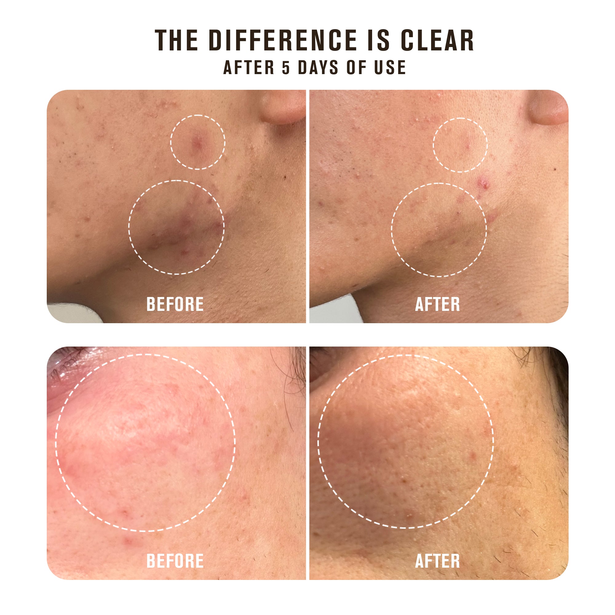 acne-spot-treatment_2